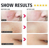 Rose Gold Pimple Extractor Beauty Kit